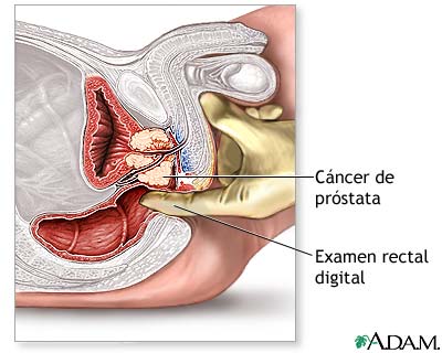 cáncer de próstata con mantequilla de manía cáncer de próstata con mantequilla de manía